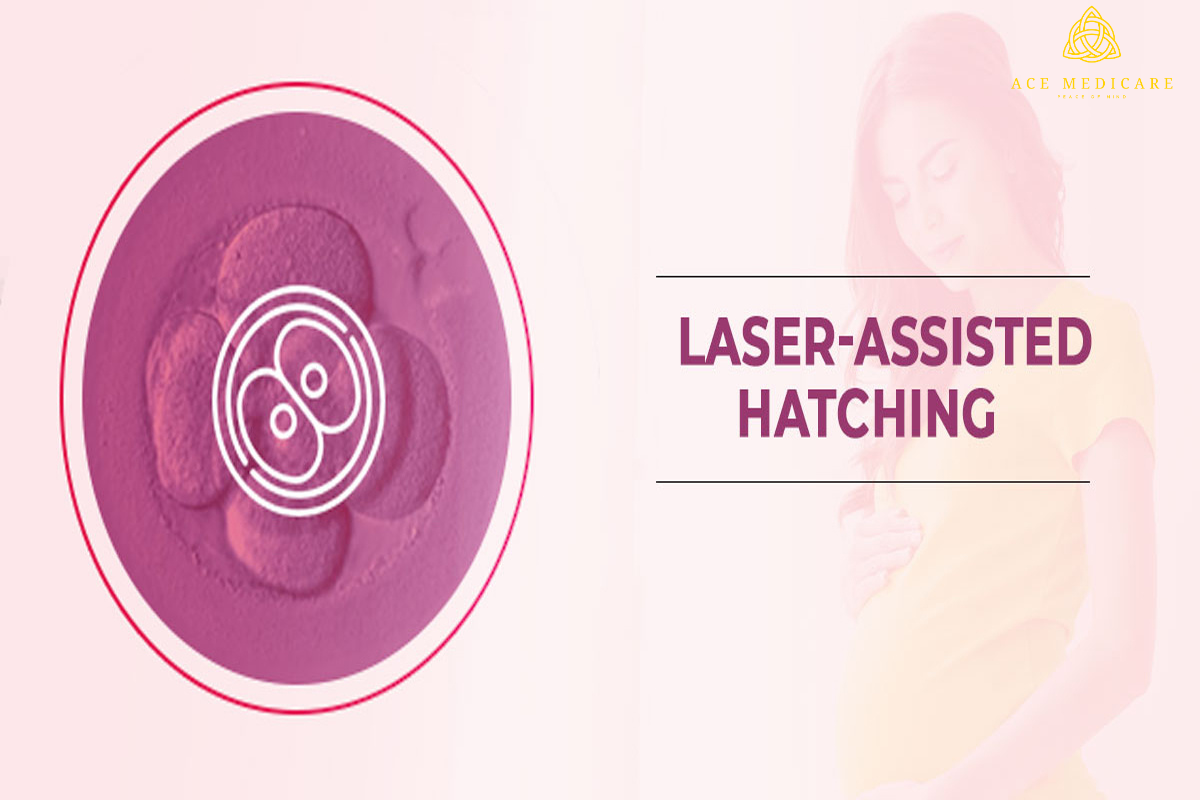 The Evolution of Laser-Assisted Hatching: A Breakthrough in Fertility Treatments